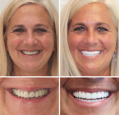 NESLEMY™ Advanced Customized Full Denture Set 7 NESLEMY™Advanced Customized Full Denture Set