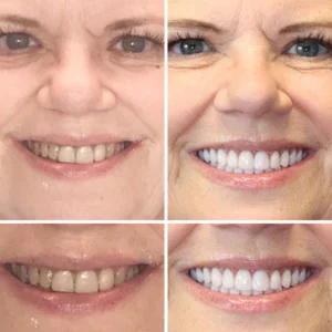 NESLEMY™ Advanced Customized Full Denture Set 17 NESLEMY™Advanced Customized Full Denture Set