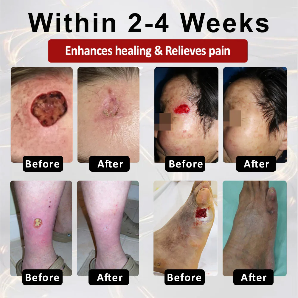 CVREOZ® DiaCure Bee Venom 4 CVREOZ® DiaCure Bee Venom & Centella Diabetic Foot Ulcer Spray