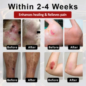 CVREOZ® DiaCure Bee Venom 13 CVREOZ® DiaCure Bee Venom & Centella Diabetic Foot Ulcer Spray