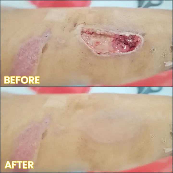 LIMETOW® Bedsore Cream 13 LIMETOW® Bedsore Cream - Image 13