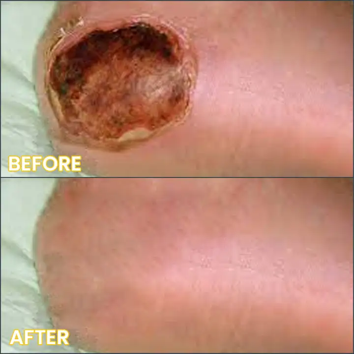 LIMETOW® Bedsore Cream 14 LIMETOW® Bedsore Cream - Image 14