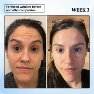 ϹΟRΟU® Nano Microneedle Wrinkle Patch 12 ϹΟRΟU® Nano Microneedle Wrinkle Patch