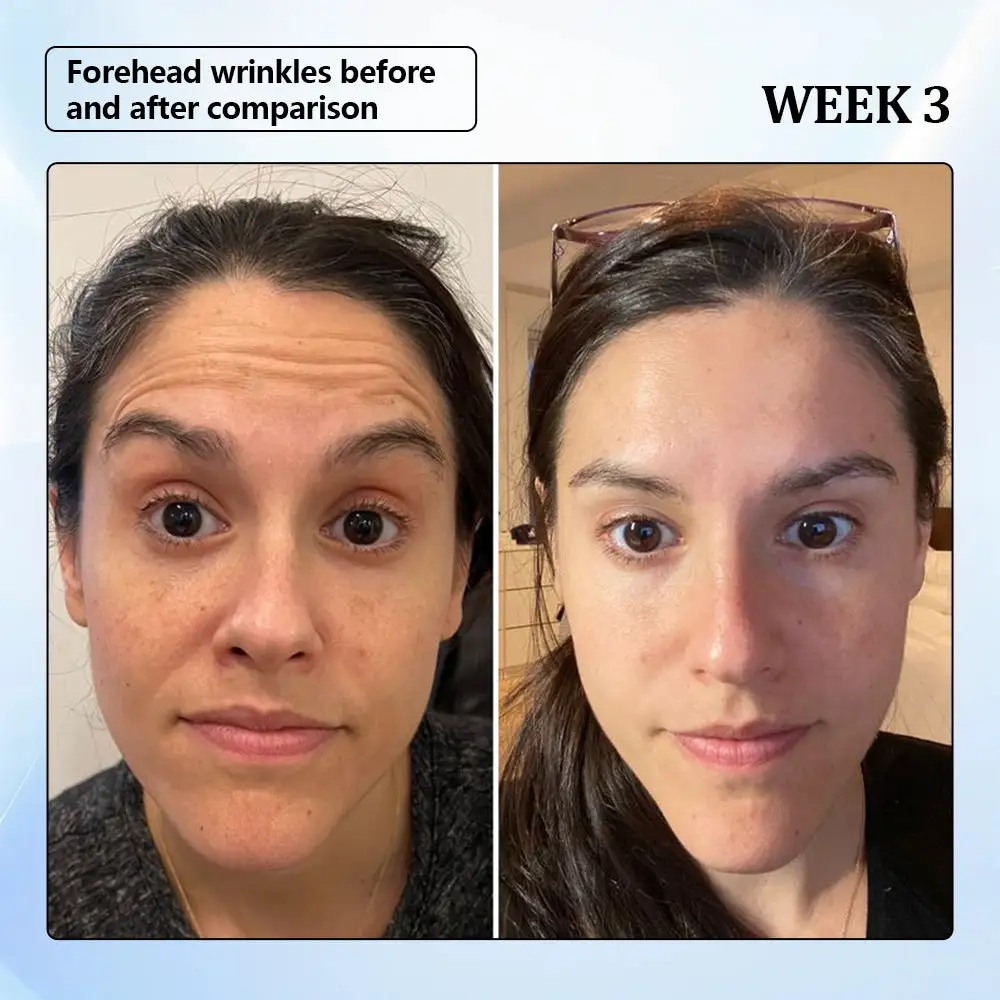 ϹΟRΟU® Nano Microneedle Wrinkle Patch 2 ϹΟRΟU® Nano Microneedle Wrinkle Patch