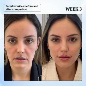 ϹΟRΟU® Nano Microneedle Wrinkle Patch 13 ϹΟRΟU® Nano Microneedle Wrinkle Patch