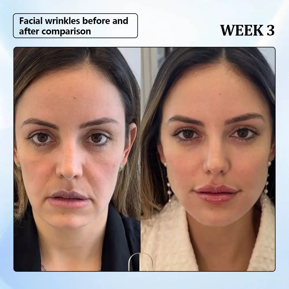 ϹΟRΟU® Nano Microneedle Wrinkle Patch 3 ϹΟRΟU® Nano Microneedle Wrinkle Patch - Image 3