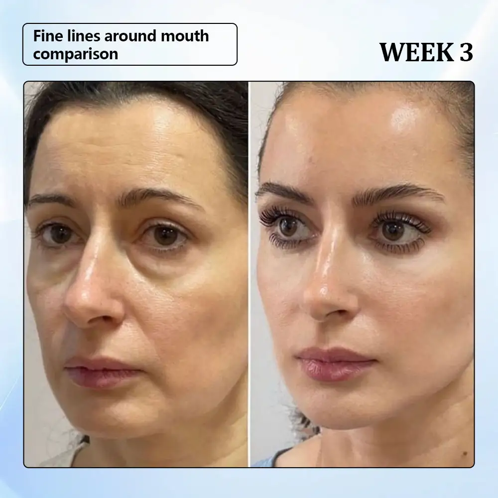 ϹΟRΟU® Nano Microneedle Wrinkle Patch 4 ϹΟRΟU® Nano Microneedle Wrinkle Patch - Image 4