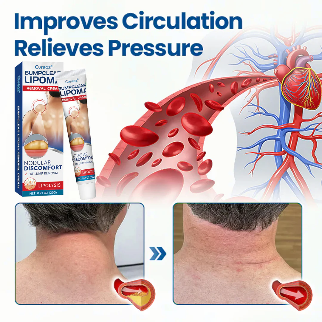 Cvreoz® BumpClear Lipoma Removal Cream 6 Cvreoz® BumpClear Lipoma Removal Cream - Image 6