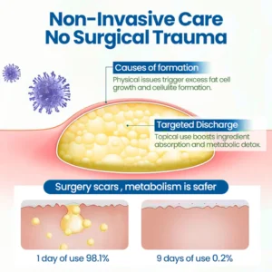 Cvreoz® BumpClear Lipoma Removal Cream 18 Cvreoz® BumpClear Lipoma Removal Cream