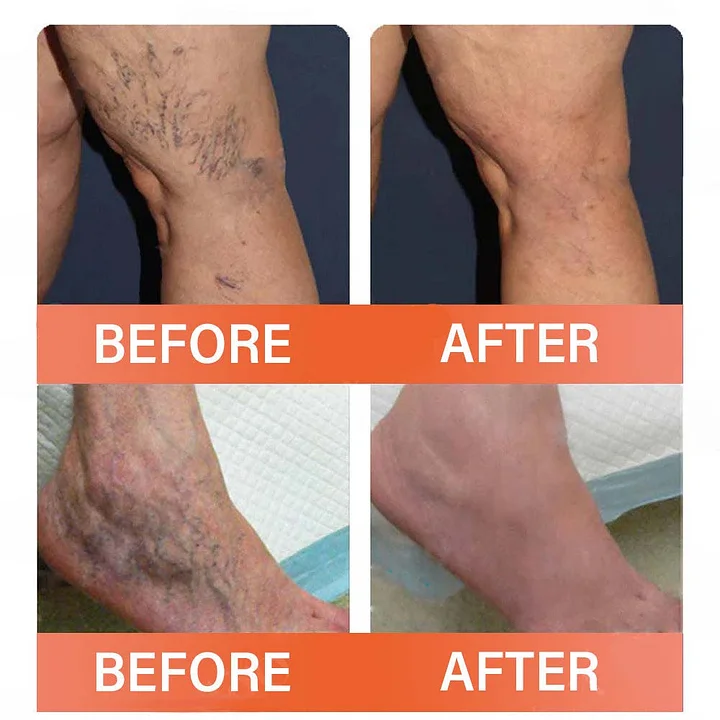 YUNPSO™ MicroVeno Microneedle Terapiya Yaması 6 YUNPSO™ MicroVeno Microneedle Terapiya Yaması