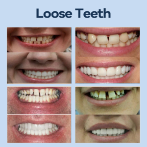 YUNPSO™– Premium Adaptive Dentures 21 YUNPSO™– Premium Adaptive Dentures