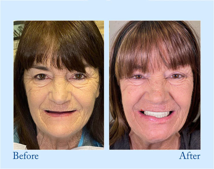 Smileasego™ - Premium Denture 5 Smileasego™ - Premium Denture