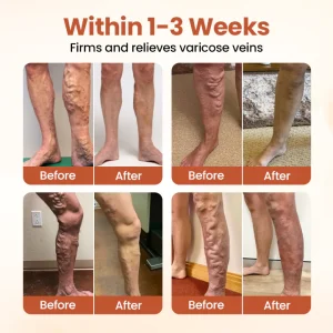 Timilk® VeinTarget Microneedle Patch 12 Timilk® VeinTarget Microneedle Patch