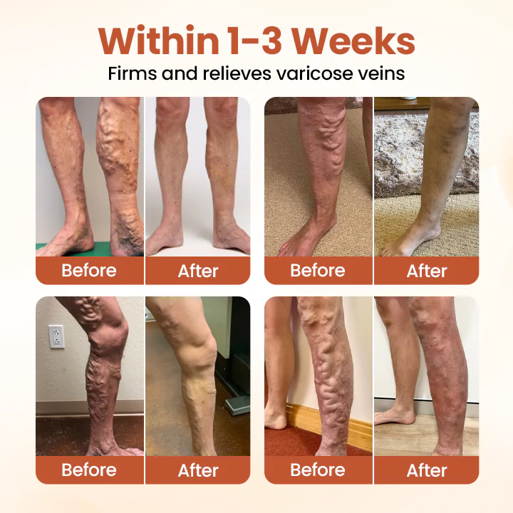 Timilk® VeinTarget Microneedle Patch 2 Timilk® VeinTarget Microneedle Patch