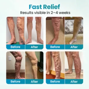 Timilk® VeinAway Relief Cream