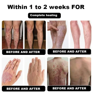 NESLEMY™ Psoriasis Cure Cream, relieves itching and restores smooth and youthful skin 14 NESLEMY™ Psoriasis Cure Cream, relieves itching and restores smooth and youthful skin