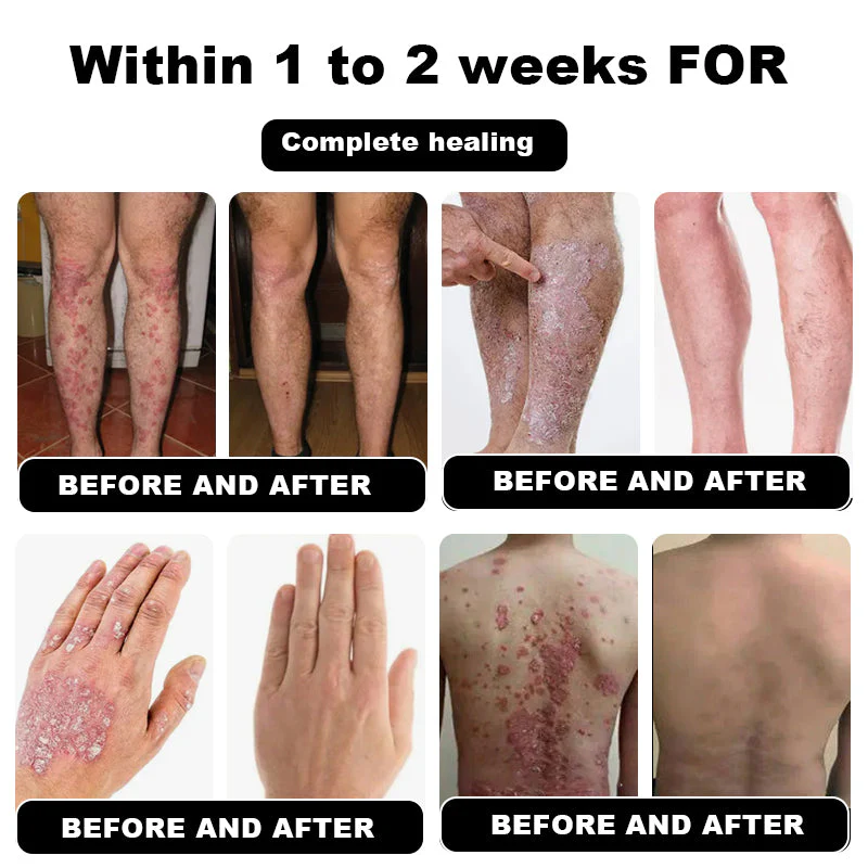 NESLEMY™ Psoriasis Cure Cream, relieves itching and restores smooth and youthful skin 4 NESLEMY™ Psoriasis Cure Cream, relieves itching and restores smooth and youthful skin - Image 4