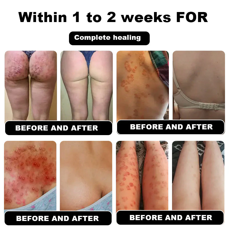 NESLEMY™ Psoriasis Cure Cream, relieves itching and restores smooth and youthful skin 5 NESLEMY™ Psoriasis Cure Cream, relieves itching and restores smooth and youthful skin - Image 5