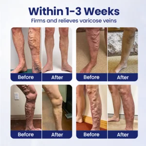 Furzero® VeinFreedom Herbal Spray - MicroMist Therapy 9 Furzero® VeinFreedom Herbal Spray - MicroMist Therapy