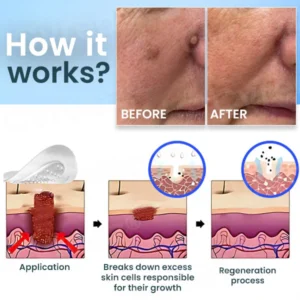 Cvreoz® Nano-Micro Needle Skin Tags Removal Patches | No More Hiding that Skin
