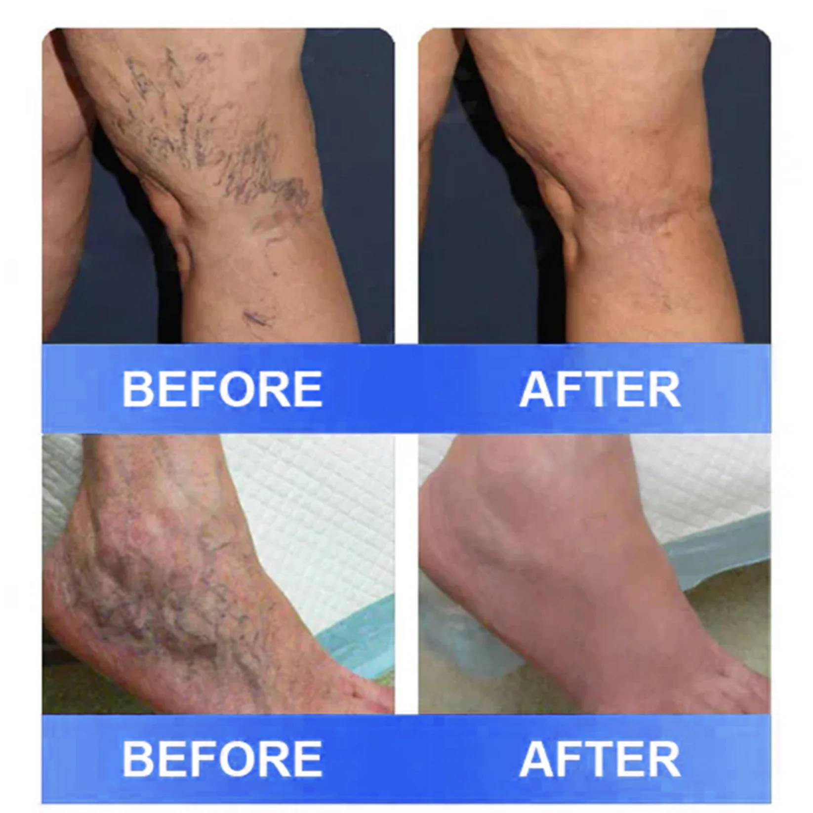 Ourlyard® Vein Ease Microneedle Care Patch - Cuttable 3 Ourlyard® Vein Ease Microneedle Care Patch - Cuttable