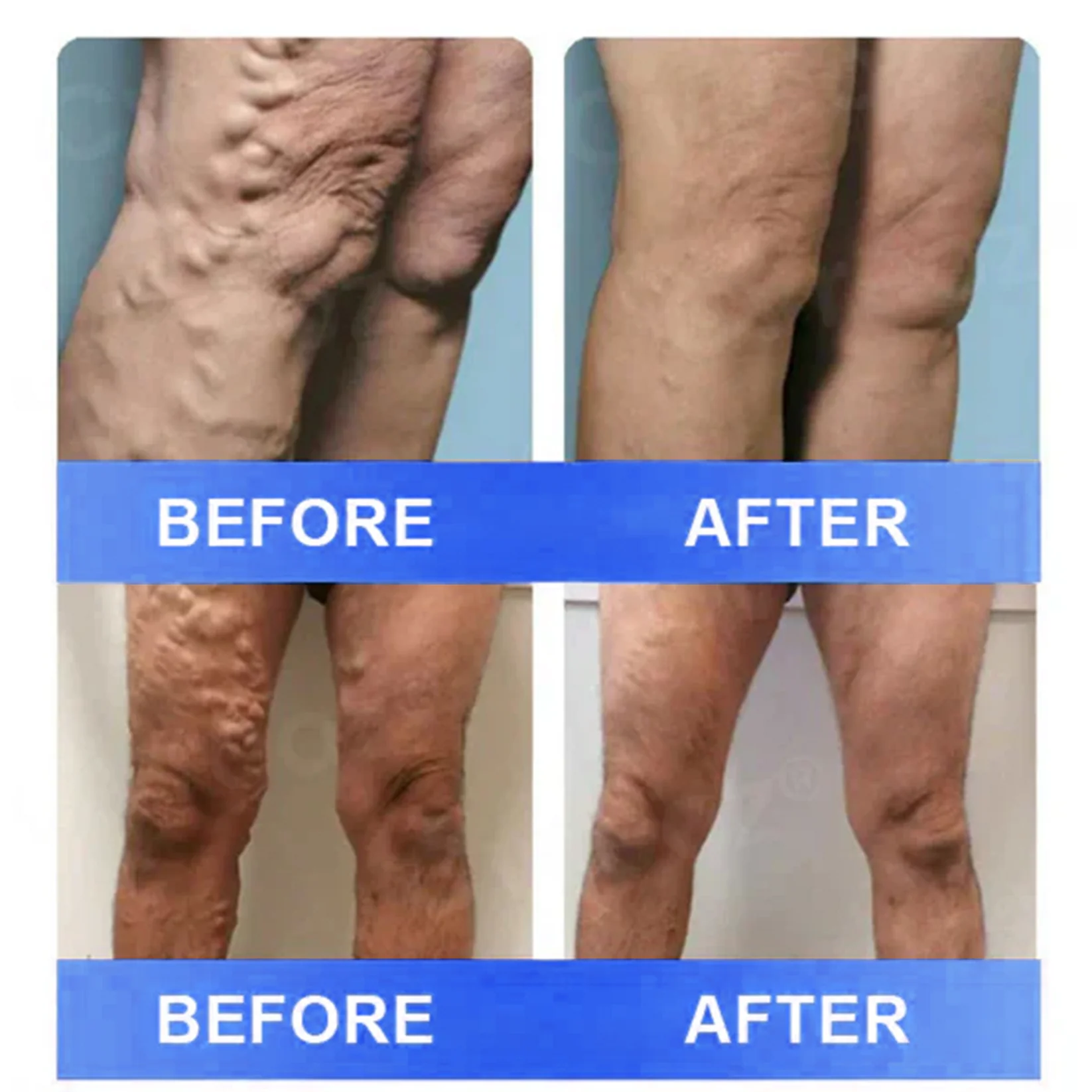 Ourlyard® Vein Ease Microneedle Care Patch - Cuttable 2 Ourlyard® Vein Ease Microneedle Care Patch - Cuttable