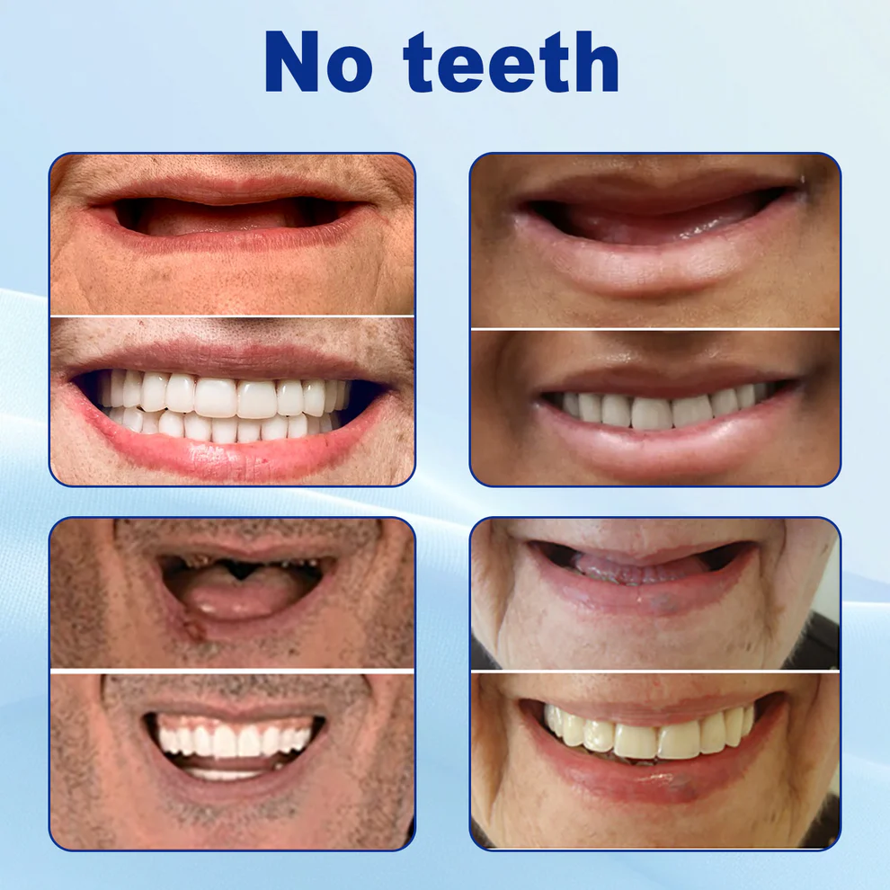 Nurbini™ Advanced Customized Full Denture Set 6 Nurbini™ Advanced Customized Full Denture Set