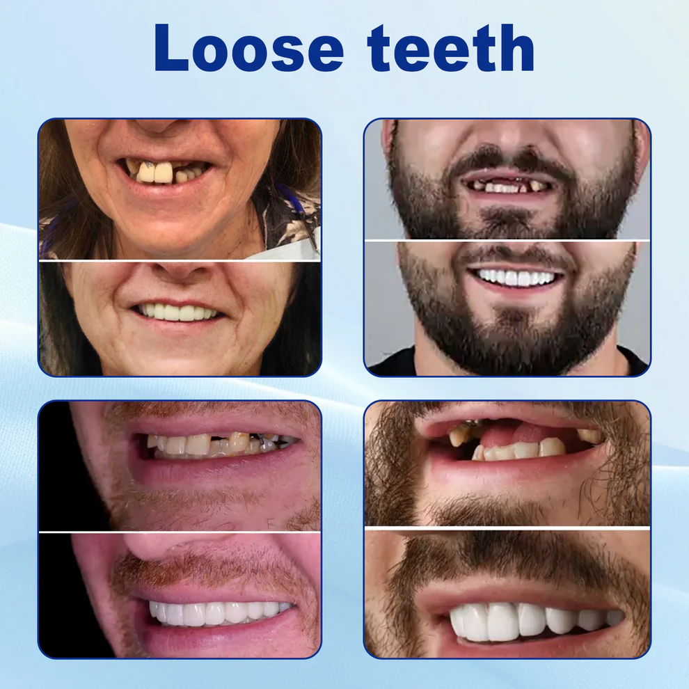 Nurbini™ Advanced Customized Full Denture Set 5 Nurbini™ Advanced Customized Full Denture Set