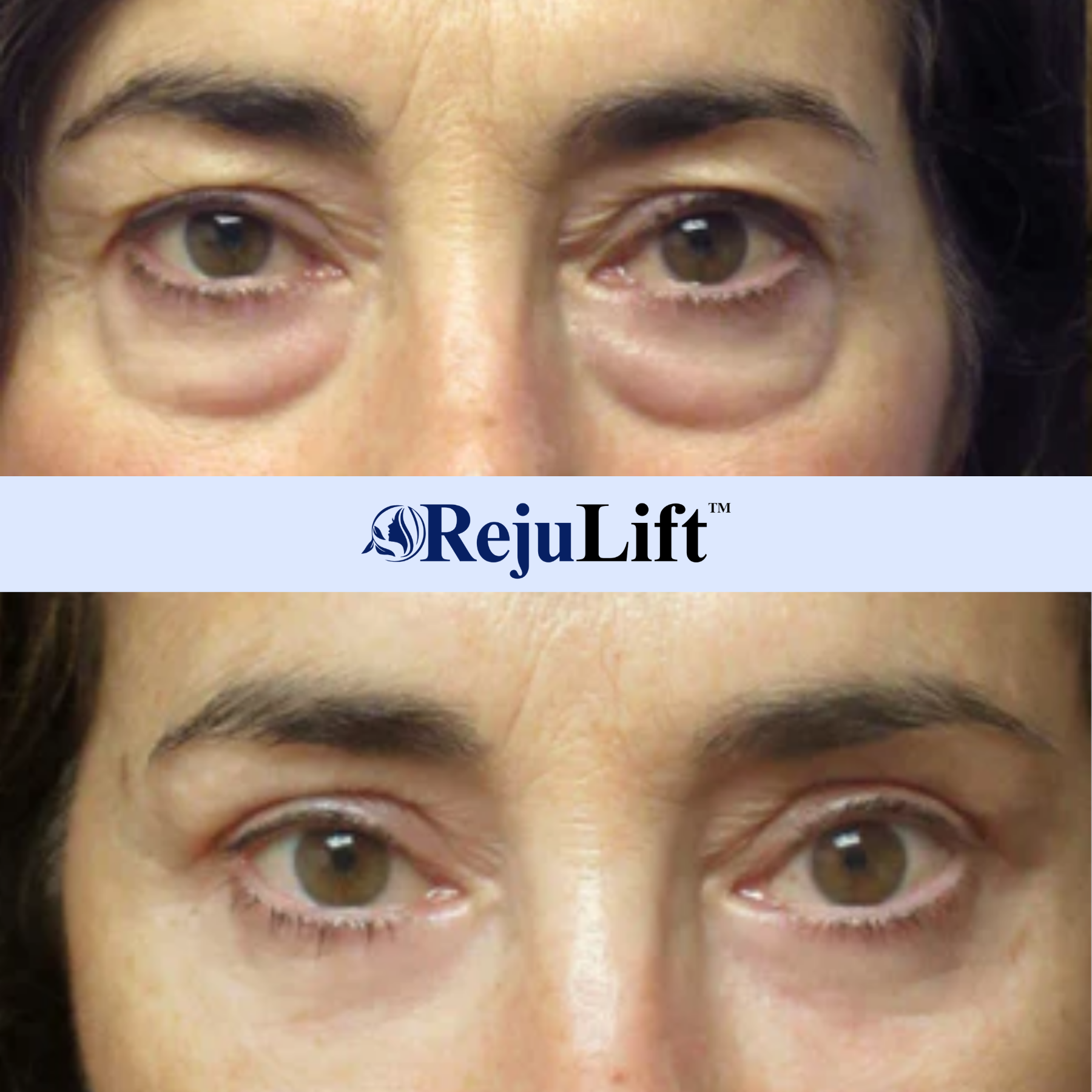 RejuLift™ Lifting Serum | Facelift without Botox 4 RejuLift™ Lifting Serum | Facelift without Botox - Image 4