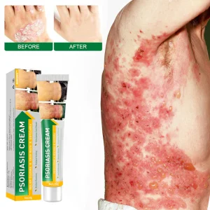 NESLEMY™ Psoriasis Cure Cream, relieves itching and restores smooth and youthful skin 20 NESLEMY™ Psoriasis Cure Cream, relieves itching and restores smooth and youthful skin