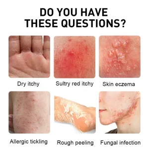 NESLEMY™ Psoriasis Cure Cream, relieves itching and restores smooth and youthful skin 12 NESLEMY™ Psoriasis Cure Cream, relieves itching and restores smooth and youthful skin