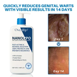 Oveallgo® NanoLipo HPV Genital Warts Eraser Cream Ultra 7 Oveallgo® NanoLipo HPV Genital Warts Eraser Cream Ultra