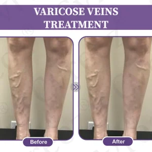 Cvreoz®DiaLeg Care Phyto Cream