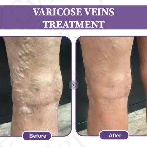 Cvreoz®DiaLeg Care Phyto Cream