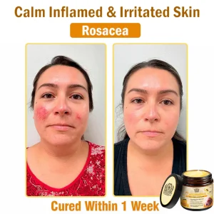 LOVILDS™ Bee Essence Skin Antibacterial Cream