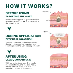 Fivfivgo® Magnesium MicroPin HPV Genital Wart Removal Patch