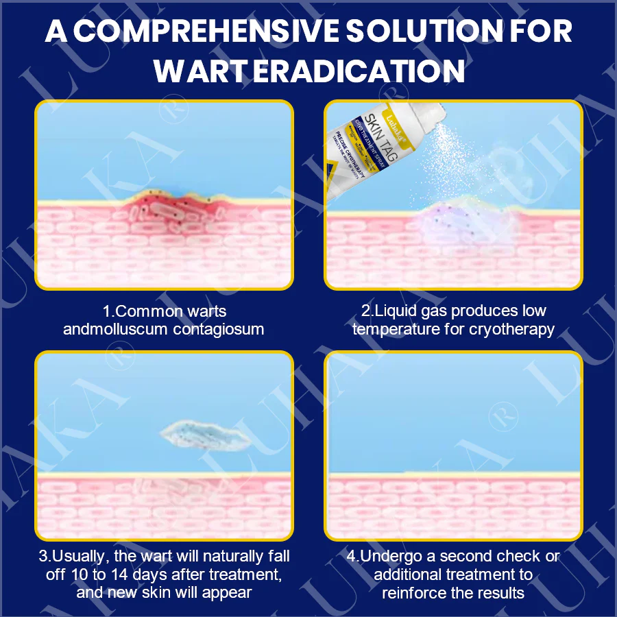 LUHAKA® SKIN TAG CRYO TREATMENT SPRAY ACE 8 LUHAKA® SKIN TAG CRYO TREATMENT SPRAY ACE