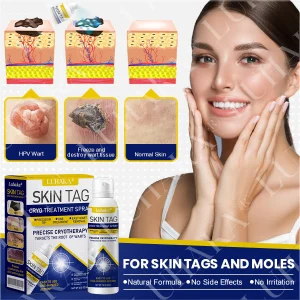 LUHAKA® SKIN TAG CRYO TREATMENT SPRAY ACE 10 LUHAKA® SKIN TAG CRYO TREATMENT SPRAY ACE