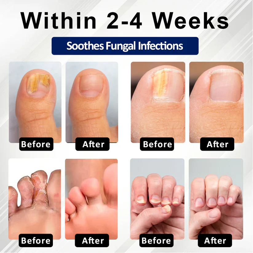 BBOJI® Fungiclear Bee Therapy Nail Spray 2 BBOJI® Fungiclear Bee Therapy Nail Spray