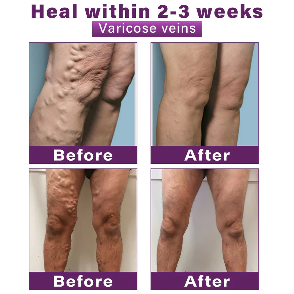 CVREOZ® Polidocanol Nano Varicose Vein Patch 5 CVREOZ® Polidocanol Nano Varicose Vein Patch