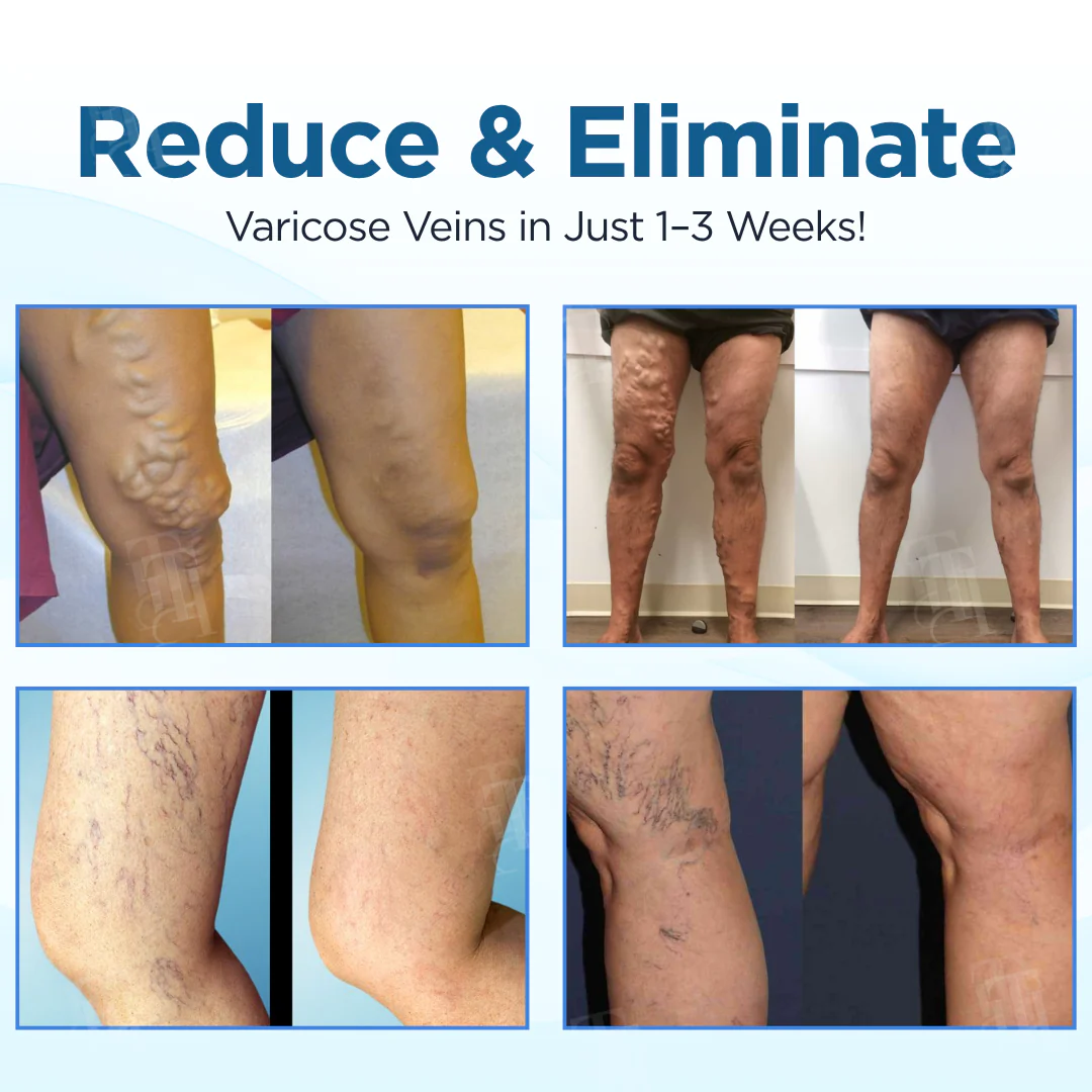 Cvreoz® Herbal Varicose Veins Treatment Spray 2 Cvreoz® Herbal Varicose Veins Treatment Spray