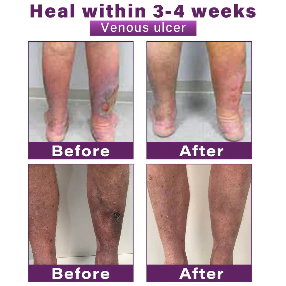 CVREOZ® Polidocanol Nano Varicose Vein Patch 7 CVREOZ® Polidocanol Nano Varicose Vein Patch