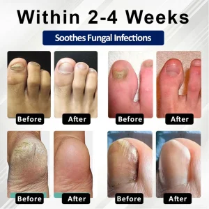 BBOJI® Fungiclear Bee Therapy Nail Spray 13 BBOJI® Fungiclear Bee Therapy Nail Spray