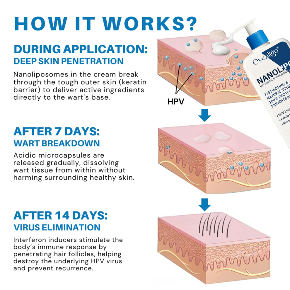 Oveallgo® NanoLipo HPV Genital Warts Eraser Cream Ultra 4 Oveallgo® NanoLipo HPV Genital Warts Eraser Cream Ultra