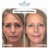 Noviqo™ – Anti-Wrinkle Freeze-Dried Nano-Silk Collagen System 3 Noviqo™ – Anti-Wrinkle Freeze-Dried Nano-Silk Collagen System