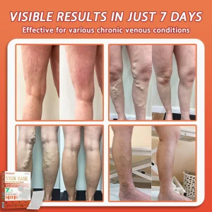 Zvoevo® Vein Ease Microneedle Care Patch 15 Zvoevo® Vein Ease Microneedle Care Patch