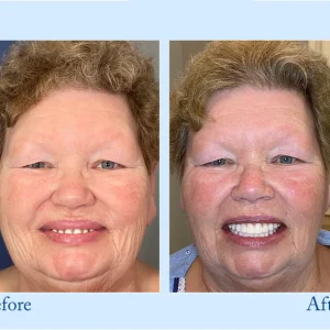 Smileasego™ - Premium Denture 17 Smileasego™ - Premium Denture