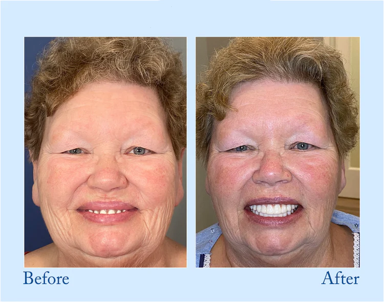 Smileasego™ - Premium Denture 6 Smileasego™ - Premium Denture