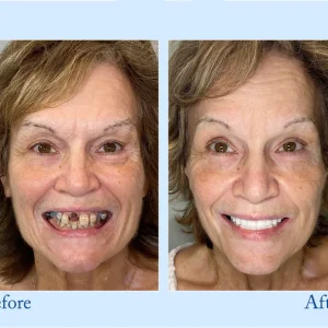 Smileasego™ - Premium Denture 18 Smileasego™ - Premium Denture