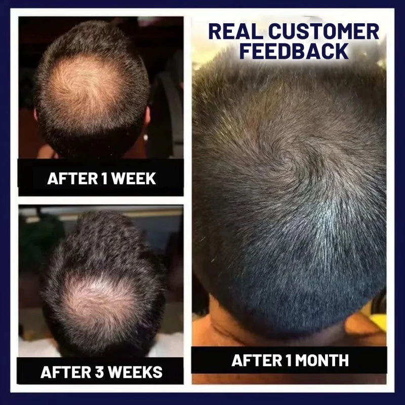 HZA™ Natural Hair Regrowth Spray 6 HZA™ Natural Hair Regrowth Spray